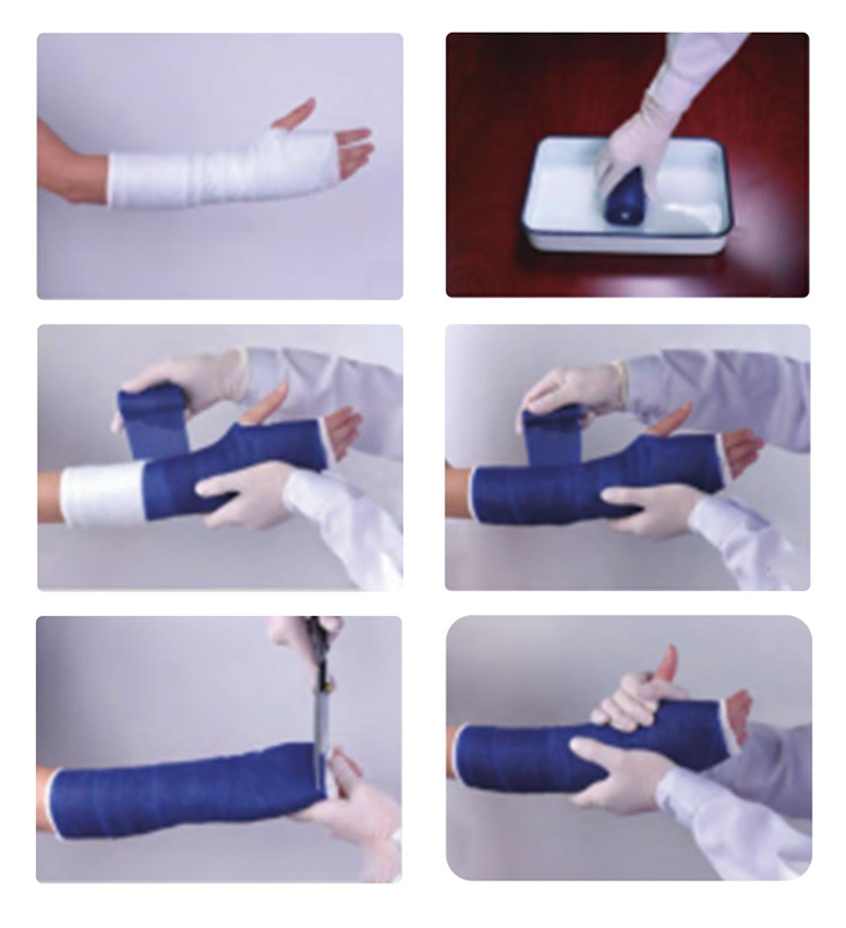Passaggi per l'utilizzo del nastro per gesso ortopedico